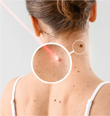 Cauterización de Verrugas (Cuello)