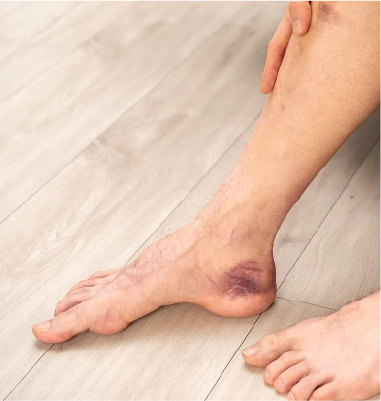 Valoración de Pie Diabético