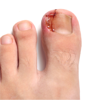 Uñas Encarnadas (Espiculotomía)